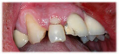 CASE #37: Broken / fractured tooth (before) CASE #37: Broken / fractured tooth (before)