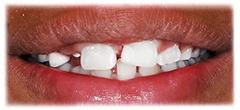 CASE #38: Emergency Treatment - Fractured tooth (after) CASE #38: Emergency Treatment - Fractured tooth (after)