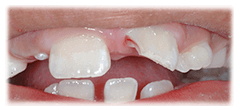 CASE #38: Emergency Treatment - Fractured tooth (before) CASE #38: Emergency Treatment - Fractured tooth (before)