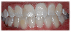 CASE #39: Emergency Treatment - Broken tooth (after) CASE #39: Emergency Treatment - Broken tooth (after)