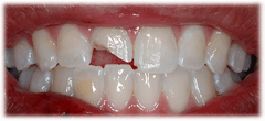 CASE #39: Emergency Treatment - Broken tooth (before) CASE #39: Emergency Treatment - Broken tooth (before)