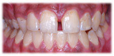 CASE # 4: General and Cosmetic Dentistry - Cleaning - Teeth Whitening (after) CASE # 4: General and Cosmetic Dentistry - Cleaning - Teeth Whitening (after)