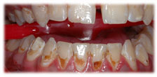 CASE # 4: General and Cosmetic Dentistry - Cleaning - Teeth Whitening (before) CASE # 4: General and Cosmetic Dentistry - Cleaning - Teeth Whitening (before)