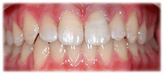 CASE #40: Emergency Treatment - Fractured Tooth (after) CASE #40: Emergency Treatment - Fractured Tooth (after)