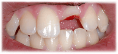 CASE #40: Emergency Treatment - Fractured Tooth (before) CASE #40: Emergency Treatment - Fractured Tooth (before)