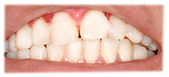 CASE #41: Emergency Treatment - Fractured Tooth (after) CASE #41: Emergency Treatment - Fractured Tooth (after)