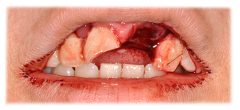 CASE #41: Emergency Treatment - Fractured Tooth (before) CASE #41: Emergency Treatment - Fractured Tooth (before)