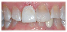 CASE # 5: Emergency Treatment - Fractured or Broken Tooth (after) CASE # 5: Emergency Treatment - Fractured or Broken Tooth (after)