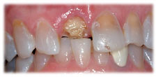 CASE # 5: Emergency Treatment - Fractured or Broken Tooth (before) CASE # 5: Emergency Treatment - Fractured or Broken Tooth (before)
