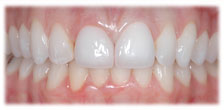 CASE # 6: Cosmetic Dentistry - All-Porcelain Crowns (after) CASE # 6: Cosmetic Dentistry - All-Porcelain Crowns (after)