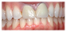 CASE # 6: Cosmetic Dentistry - All-Porcelain Crowns (before) CASE # 6: Cosmetic Dentistry - All-Porcelain Crowns (before)