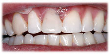 CASE #7: Emergency Treatment - Fractured Tooth (after) CASE #7: Emergency Treatment - Fractured Tooth (after)