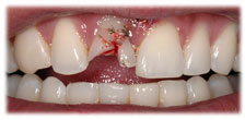 CASE #7: Emergency Treatment - Fractured Tooth (before) CASE #7: Emergency Treatment - Fractured Tooth (before)