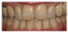 CASE #8: Cosmetic Dentistry - Teeth Whitening (before) CASE #8: Cosmetic Dentistry - Teeth Whitening (before)