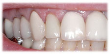 CASE #9: Emergency Treatment - Fractured Tooth (after) CASE #9: Emergency Treatment - Fractured Tooth (after)