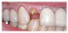 CASE #9: Emergency Treatment - Fractured Tooth (before) CASE #9: Emergency Treatment - Fractured Tooth (before)