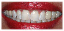 Teeth Whitening after